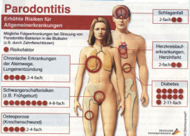 Parodontitis und Allgemeinerkrankungen ©Chlorhexamed/Dt. Infografikdienst