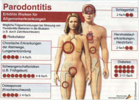 Parodontitis und Allgemeinerkrankungen ©Chlorhexamed/Dt. Infografikdienst